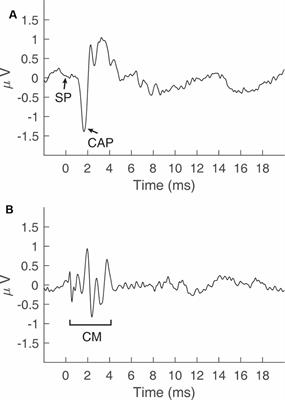 Techniques for Obtaining High-quality Recordings in Electrocochleography